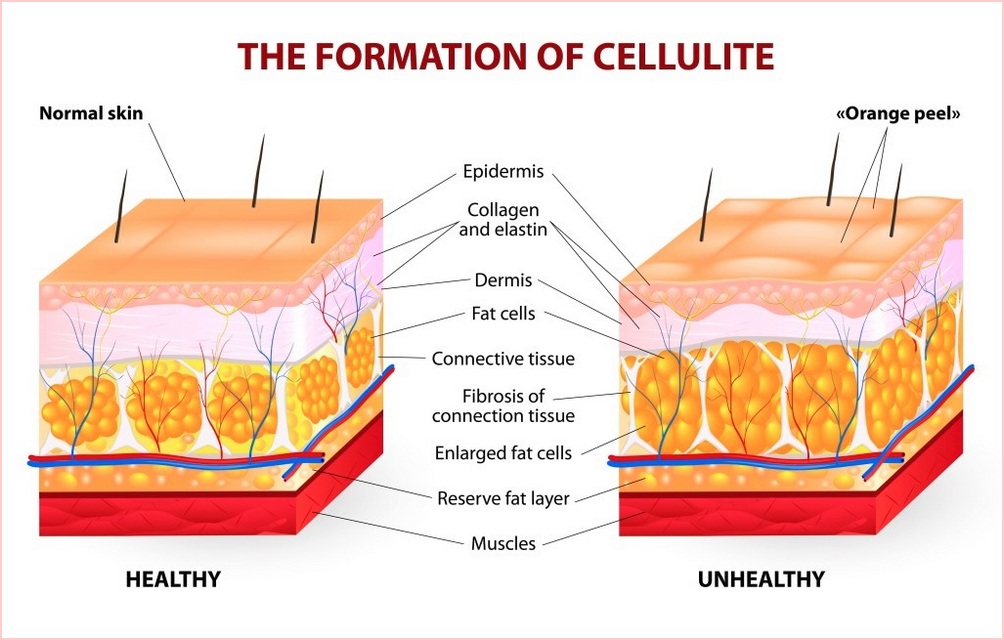 Cellulite Formation